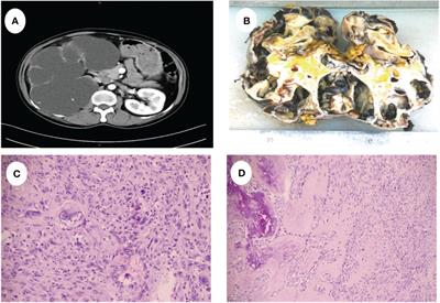 Case report: Sarcomatoid renal cell carcinoma masquerading as hydronephrosis